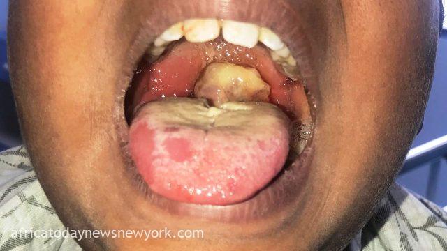 453 Nigerians Have Been Lost To Diphtheria In 18 States – FG