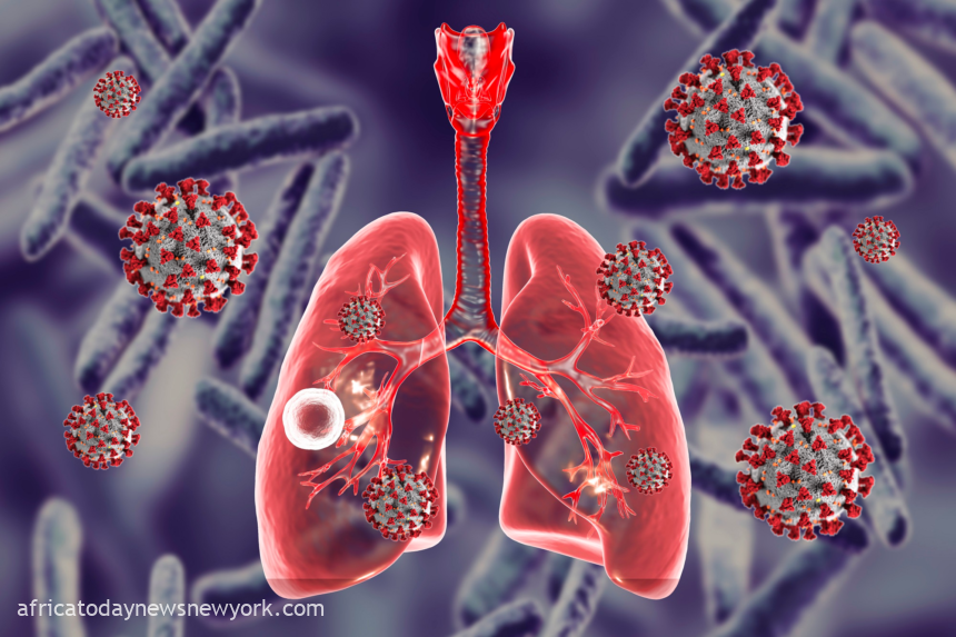 African TB Cases Reached 2.5 Million In 2022, WHO Says